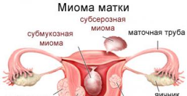 Міома матки: причини, лікування, ускладнення